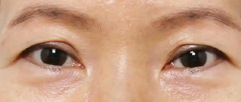 一,导致上眼睑松弛的原因