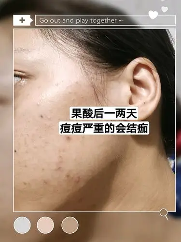 做完果酸换肤红蓝光的王炸组合一周了,脸上之前比较严重的大痘痘现在