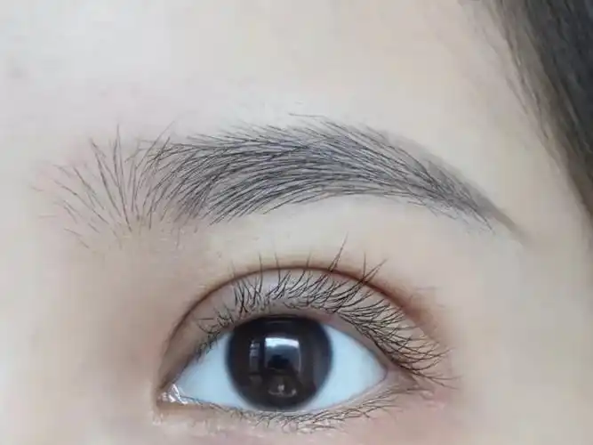 北京全切双眼皮高清恢复过程分享