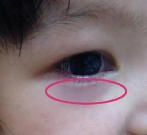 若是孩子眼睛出现4种信号,脾胃八成已"烂如渔网",父母别大意_下眼睑