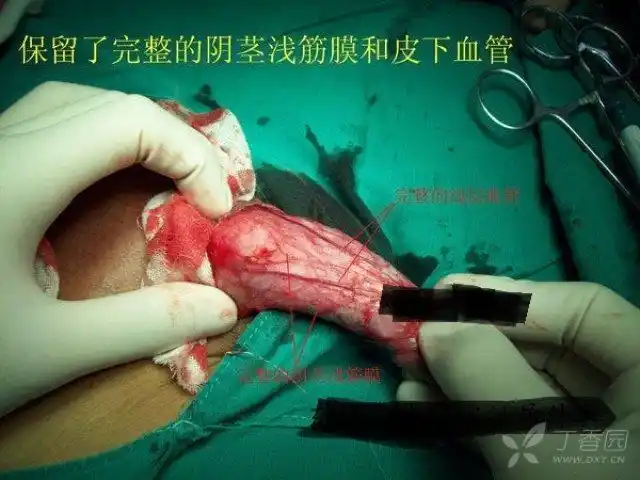 【其它】包皮环切(刀切法)是用刀片切还是用剪刀剪