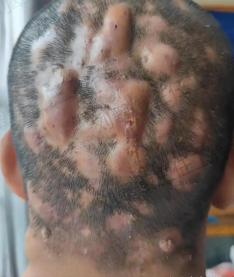 头上长脓包10年,中医辨证治疗2个月,脓包小了,长出新的头发茬!