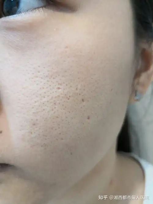 脸上毛孔粗大该怎么办?湘西俪人