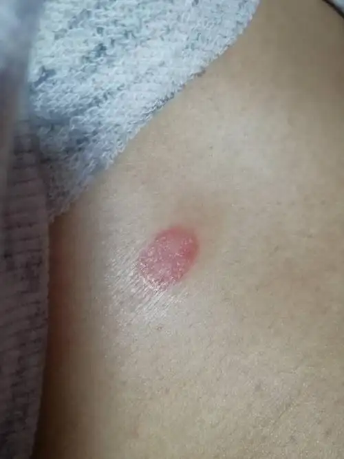 帮忙看下这是什么皮肤病?