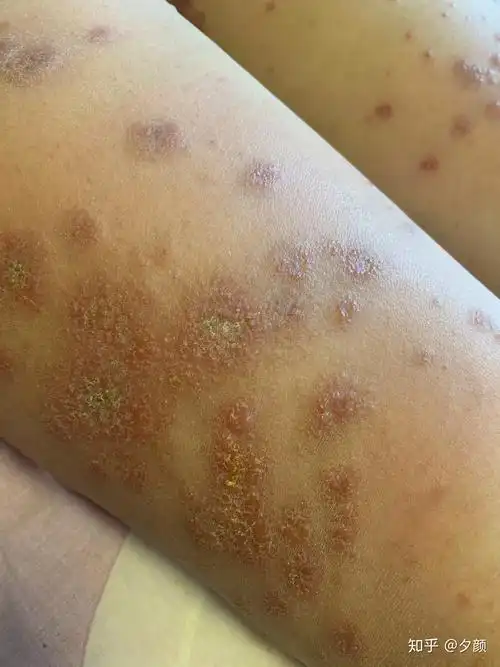 在抗击湿疹的日子里8