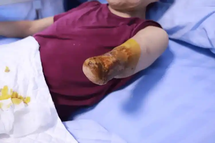 大姐突遭车祸,截肢后伤口难愈,医生:治疗确实有些困难!