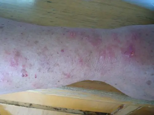 皮肤病体癣一例