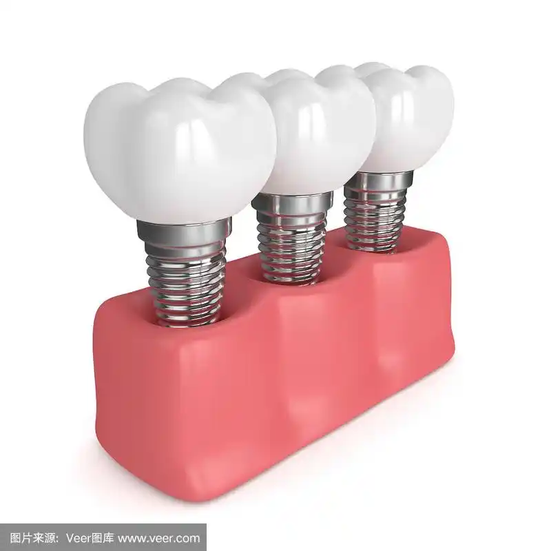 牙种植体在牙龈的3d渲染