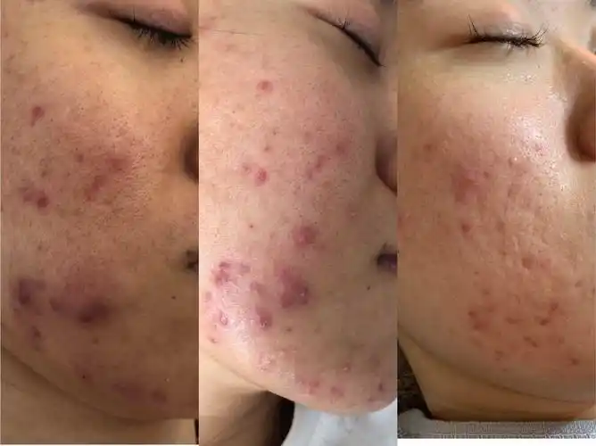 皮肤屏障是什么受损了该如何针对性去修复