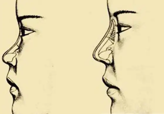 p>人们常说的塌鼻梁,又称 a href="#" data-lemmaid="6021122">鞍鼻