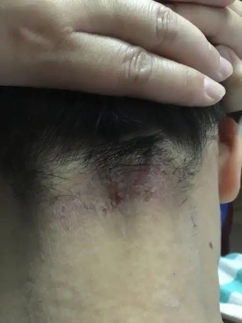 八岁孩子脖子后面溃烂结痂,涂过一些软膏,坚持用就有好转,一停药就起!