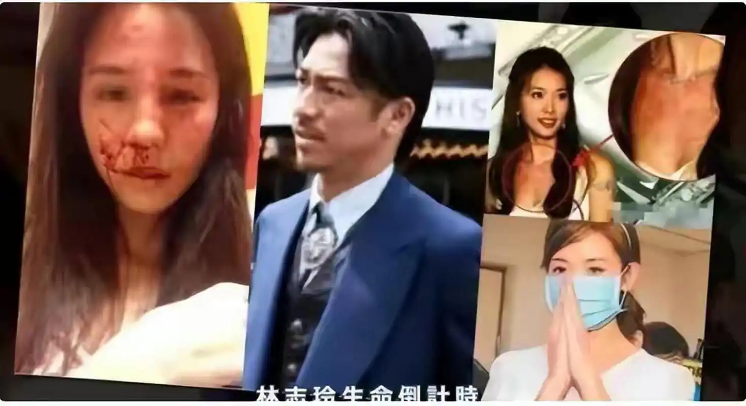 据爆料,已经结婚的林志玲被家暴,鼻子假体也被打歪,据传闻,林志玲这