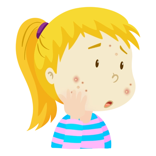 孩子脸上长的不光是"青春痘",乱挤小心越来越多!