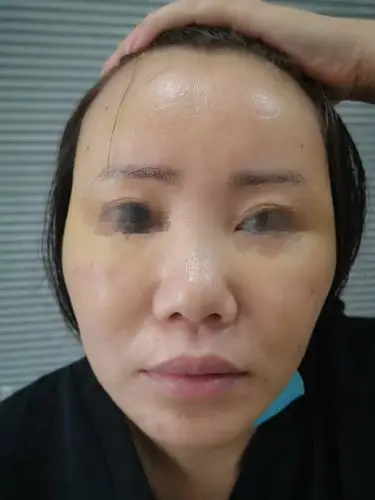 全面部脂肪填充术后术前对比 - 好大夫在线