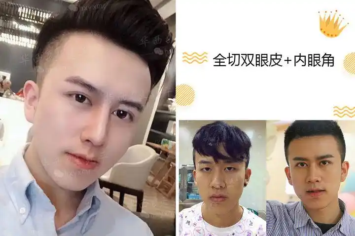 如何看待高考结束后扎堆割双眼皮,其中男生占比 20%?