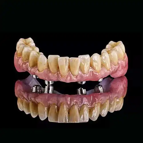 种植桥架(树脂修复)