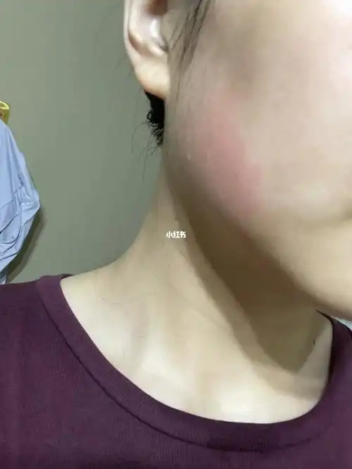 泛红_敏感肌_红血丝修复_过敏_刘亦菲_修复红血丝敏感肌_医疗健康