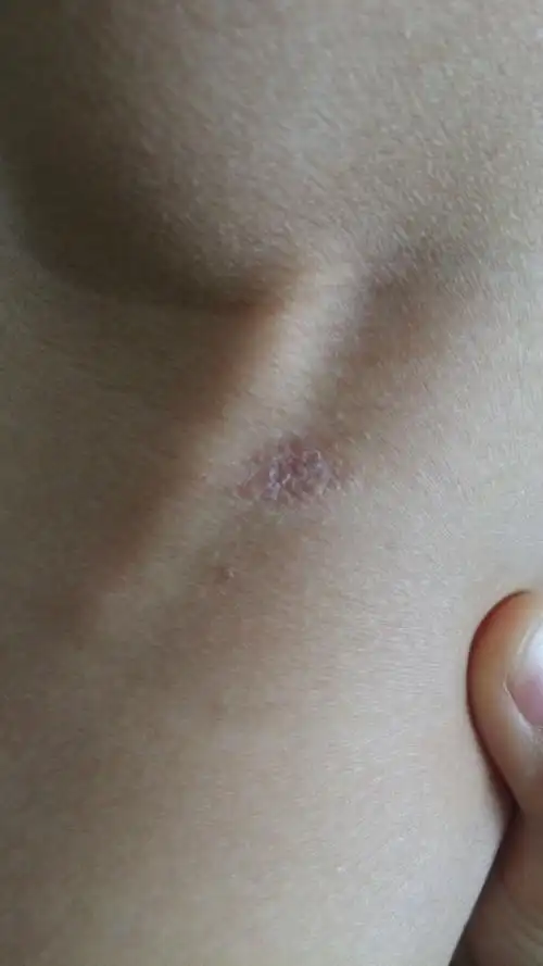 是的话,是什么癣,用什么药?