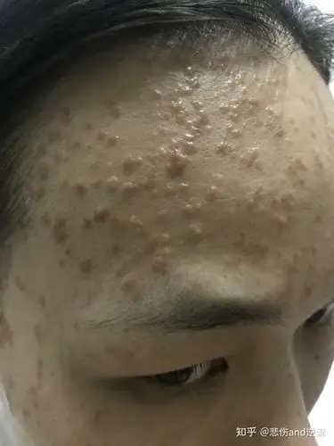 9年扁平疣,突然治(自)愈