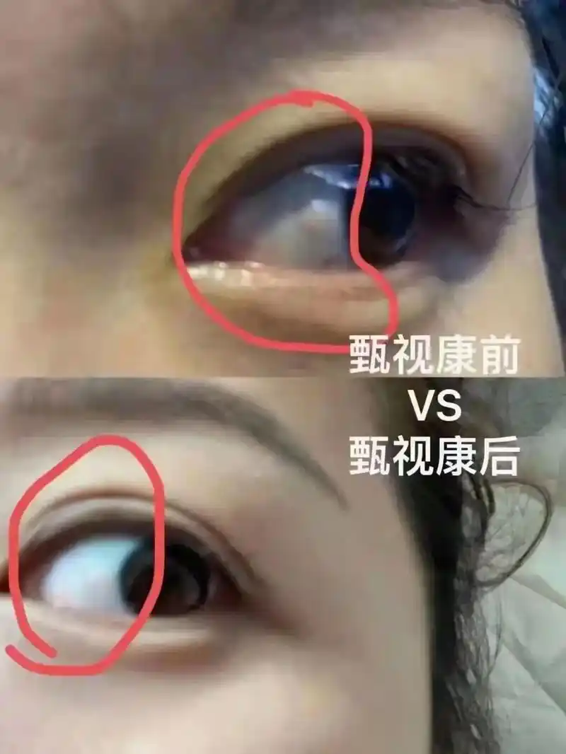 [玫瑰]胬肉,拼音:nǔ ròu, 中医指眼球结膜增生而突起 - 抖音