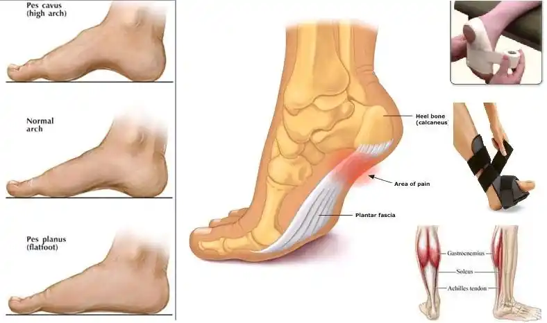 怎么改善足底筋膜炎带来的疼痛