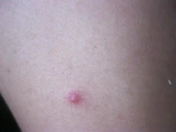 艾滋病急性期_艾滋病检测试剂盒_艾滋有急性咽喉炎症状吗