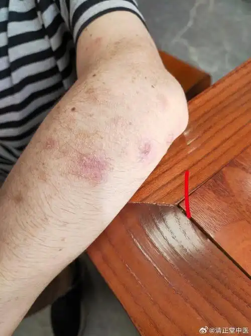 中医##经方##湿疹##皮肤