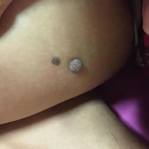 想请问这种黑色的疙瘩是什么东西?在大腿内侧