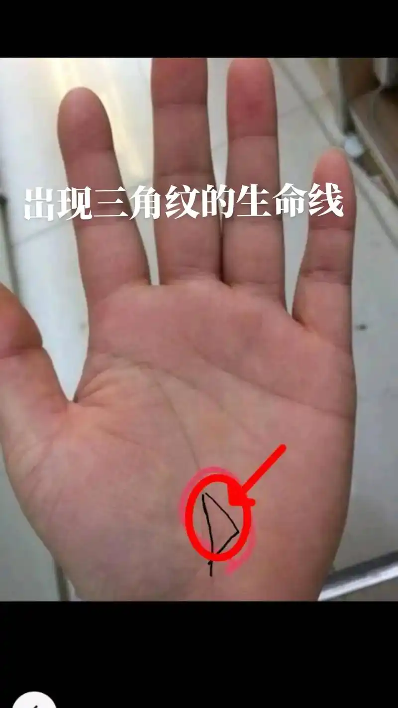 出现三角纹的生命线