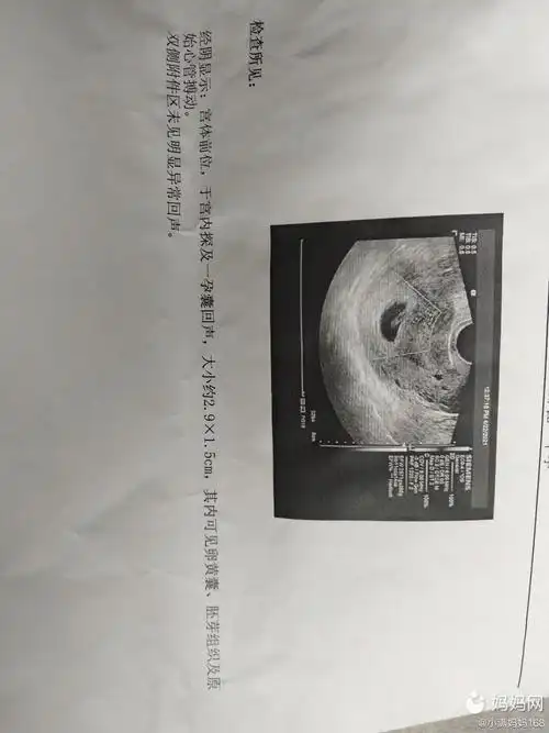 热乎乎的胎心胎芽,50天,终于放心了