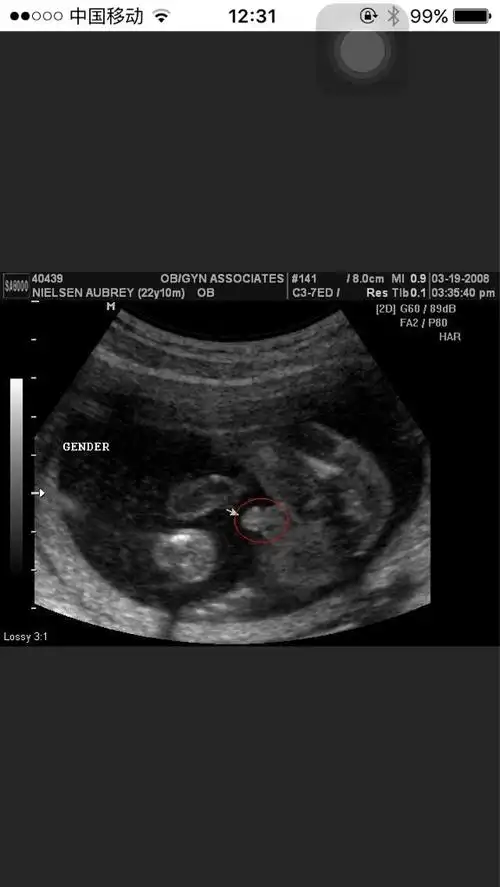 思维的看不懂,彩超的男孩是明显的小鸡鸡,女孩的是3条小白线!