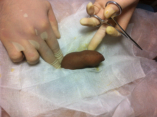 做完包皮手术丁丁变短了吗