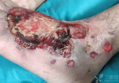 最近遇到一个疑难案例:老年女患,双足,足踝区皮肤溃疡病因不明