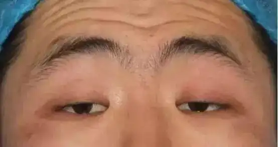这是上睑下垂的一种体现,但还不是最严重的,最严重的上睑下垂连眼睛都