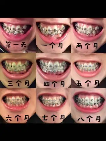 成都正畸牙齿『reco必看攻略』 虎牙 牙列拥挤 牙釉质缺损牙齿整形