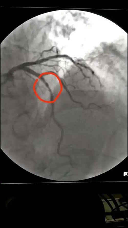 纪实:心血管内科冠脉造影术日