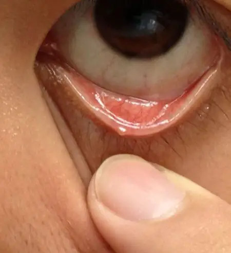 下眼睑上长了一粒黄色的突起,而且好像在扩大,是什么东西?用什么药?