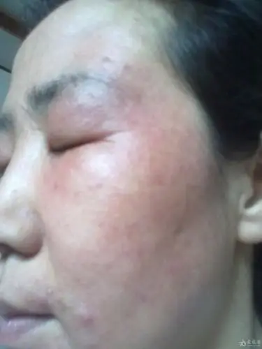 面部过敏性还是激素依赖性皮炎啊?