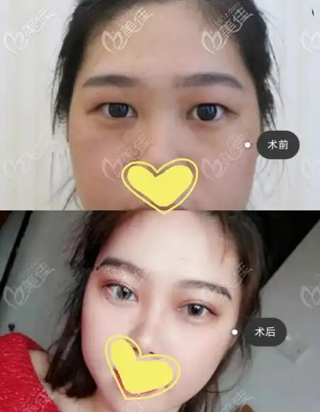 肿眼泡抽脂后眼皮会变松弛吗有没有抽眼皮脂肪前后对比图参考一下