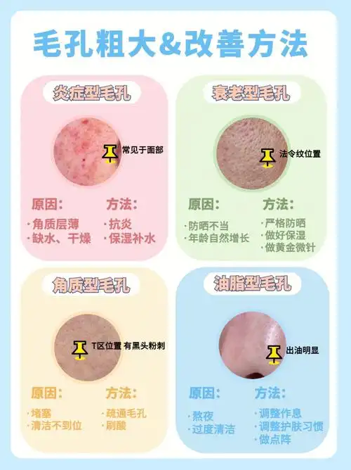 毛孔粗大怎么办71分清毛孔粗大类型75正确护肤