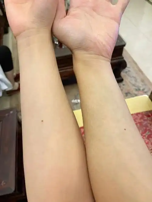 玄学手臂内壁都有颗痣唉