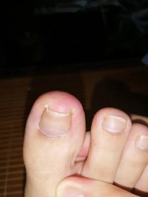 我的大脚趾怎么了