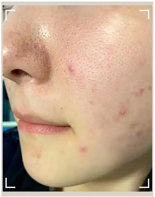 没有考虑到自己皮肤适合不适合,其实并不是所有产品都适合我们.