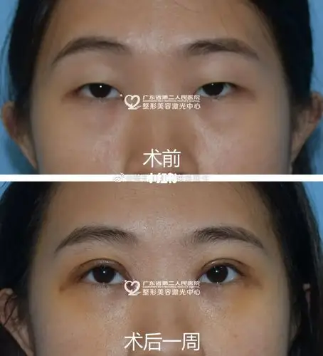 案例分享:上睑下垂矫治术