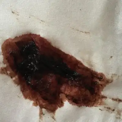 到底怎麼回事啊,这两天一直流褐色的分泌物和黑色异物