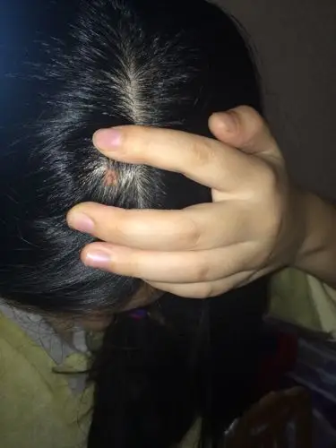 谁知道这是什么 我的头皮上长了一个这样的包 抠不掉 感觉像一块肉似