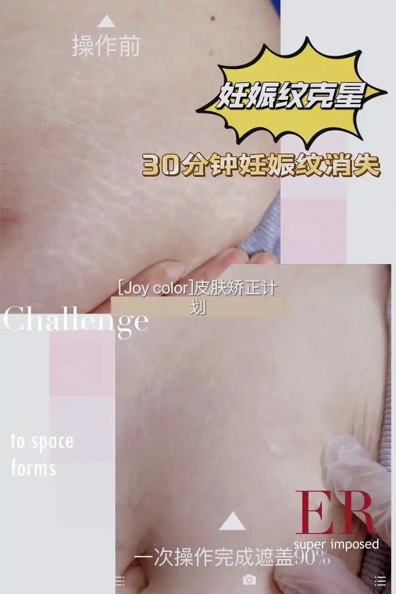 露肚脐的季节就要到啦～肚子上的纹路说拜拜.