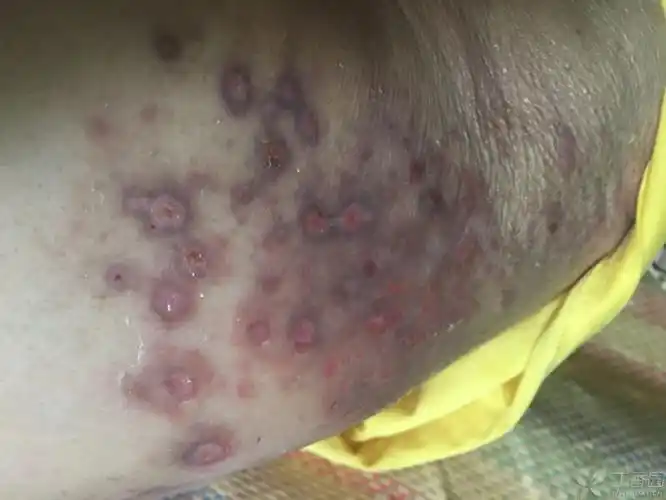 脑梗病史,现右侧肢体肌肉萎缩,活动受限,近期出现皮肤瘙痒后溃烂,主要