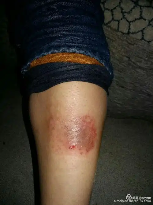 皮肤病展示图片