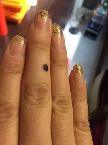 半年前右手中指突然长了一颗痣,而且现在越来越大,我想咨询下到底是